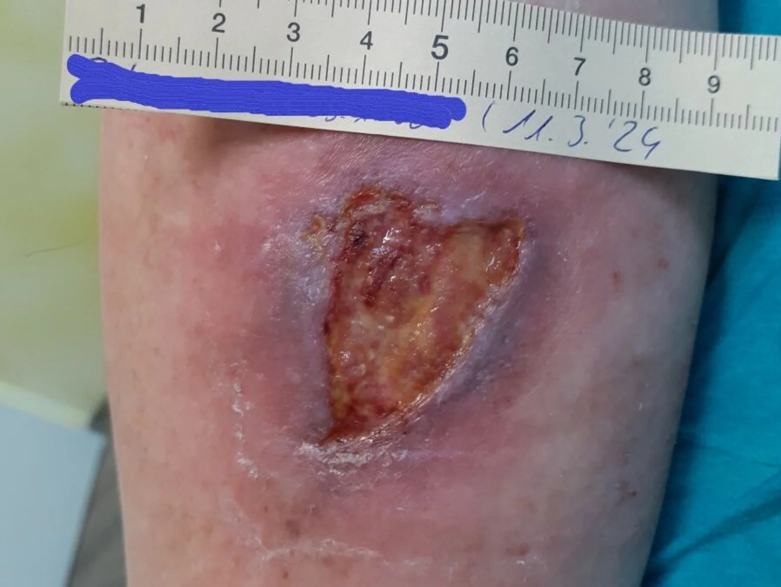 Pyoderma gangraenosum, Fallbeispiel: Ausgangssituation