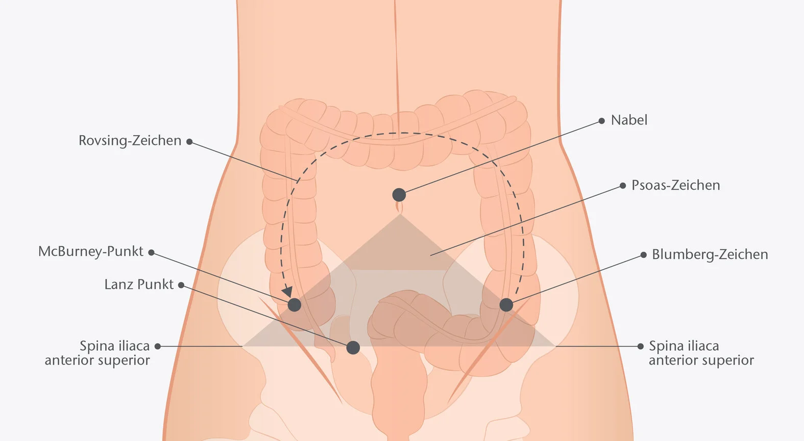 Schema: Druck- und Schmerzpunkte bei Verdacht auf Appendizitis