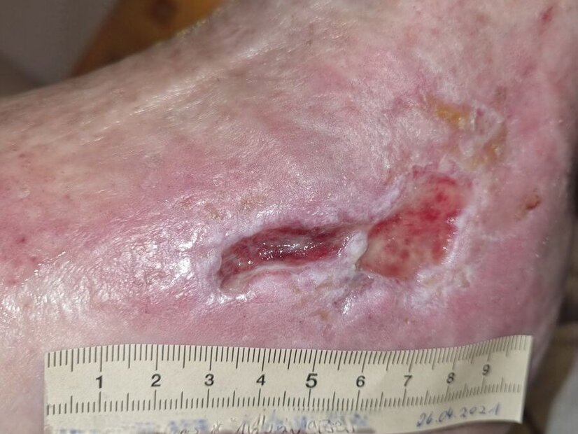 Ulcus cruris mixtum am linken Knöchel – nach 3 Monaten Ulcus cruris mixtum am linken Knöchel – nach 3 Monaten