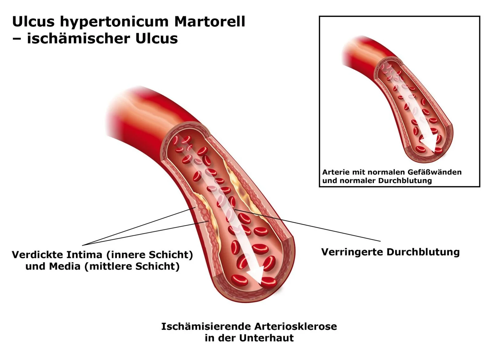 Durchblutung beim Ulcus hypertonicus Martorell, schematische Darstellung