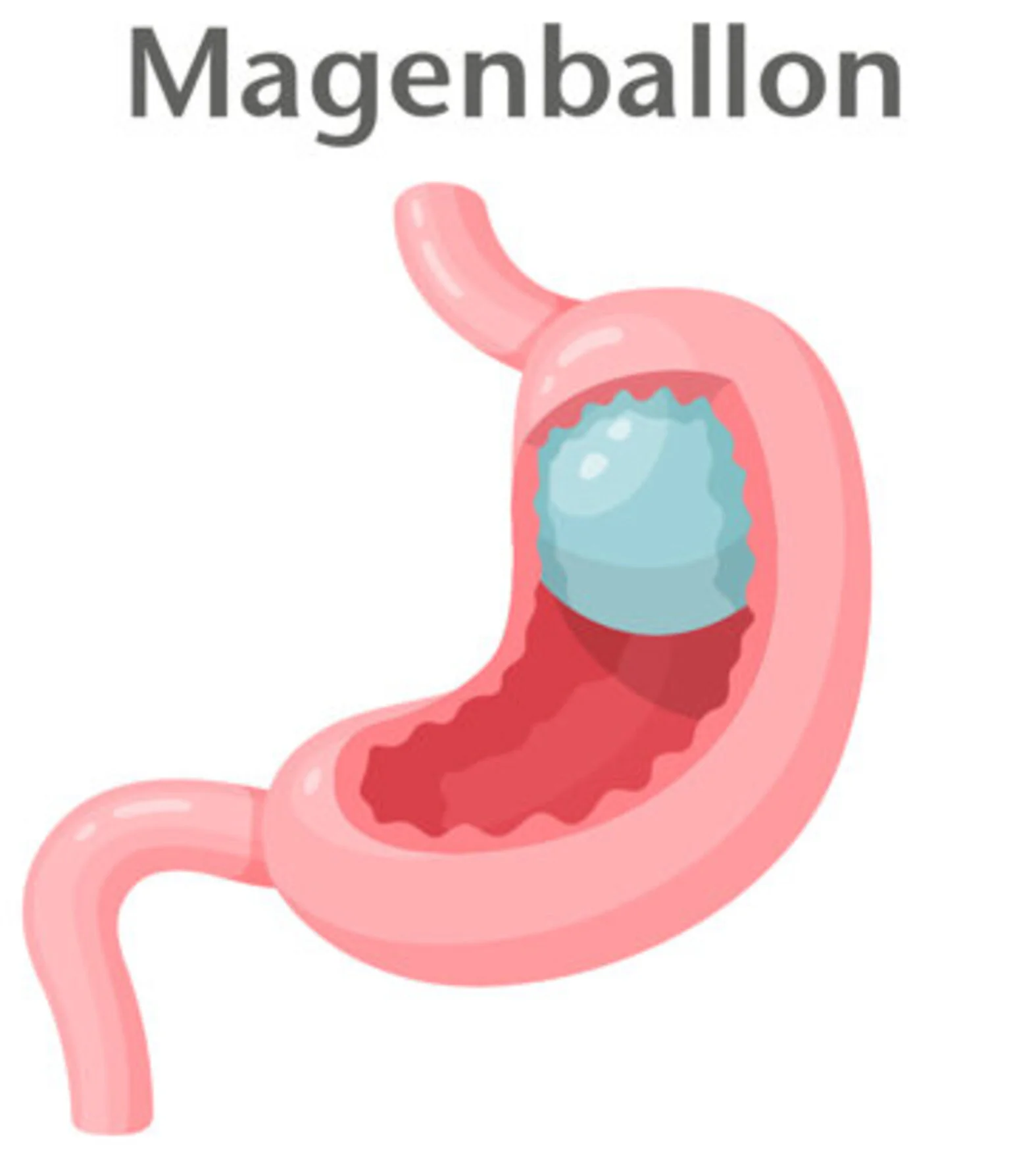 Magenballon, Methode der Adipositaschirurgie (Schema)