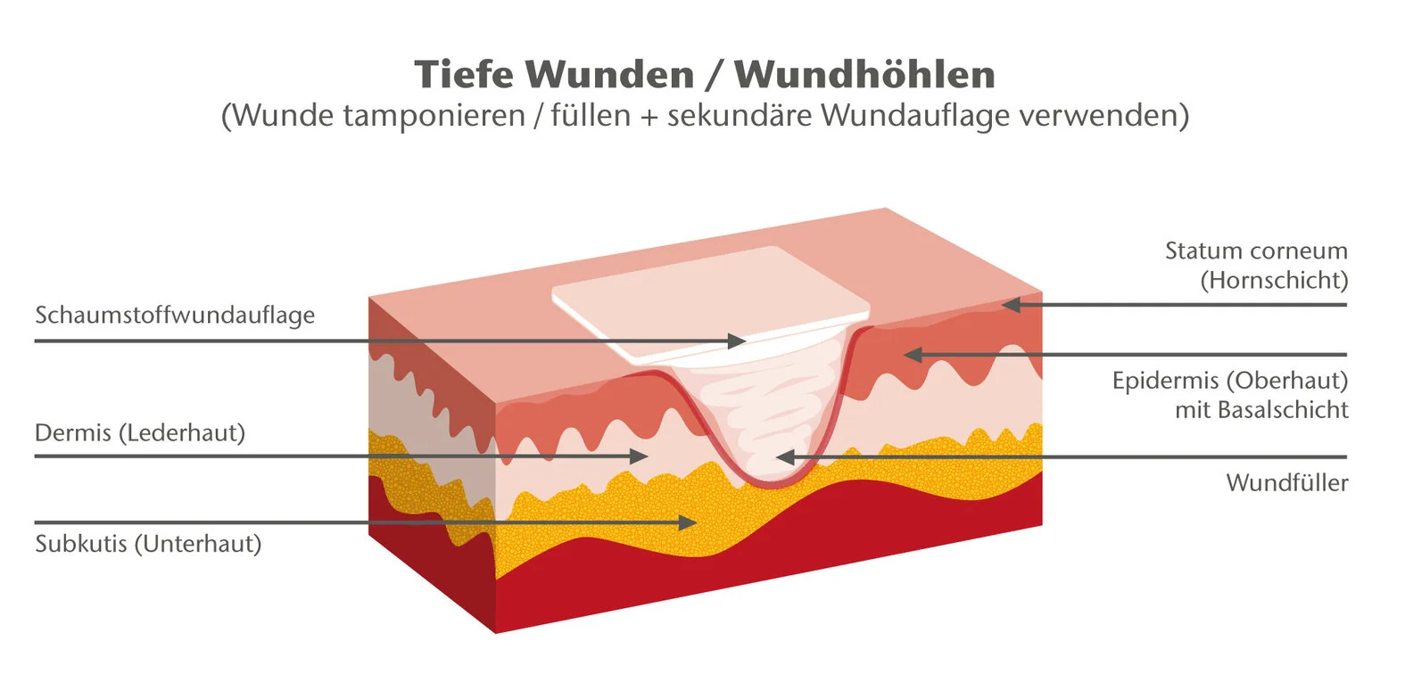 Tiefe Wunde mit Wundfüller und Wundauflage, schematische Darstellung