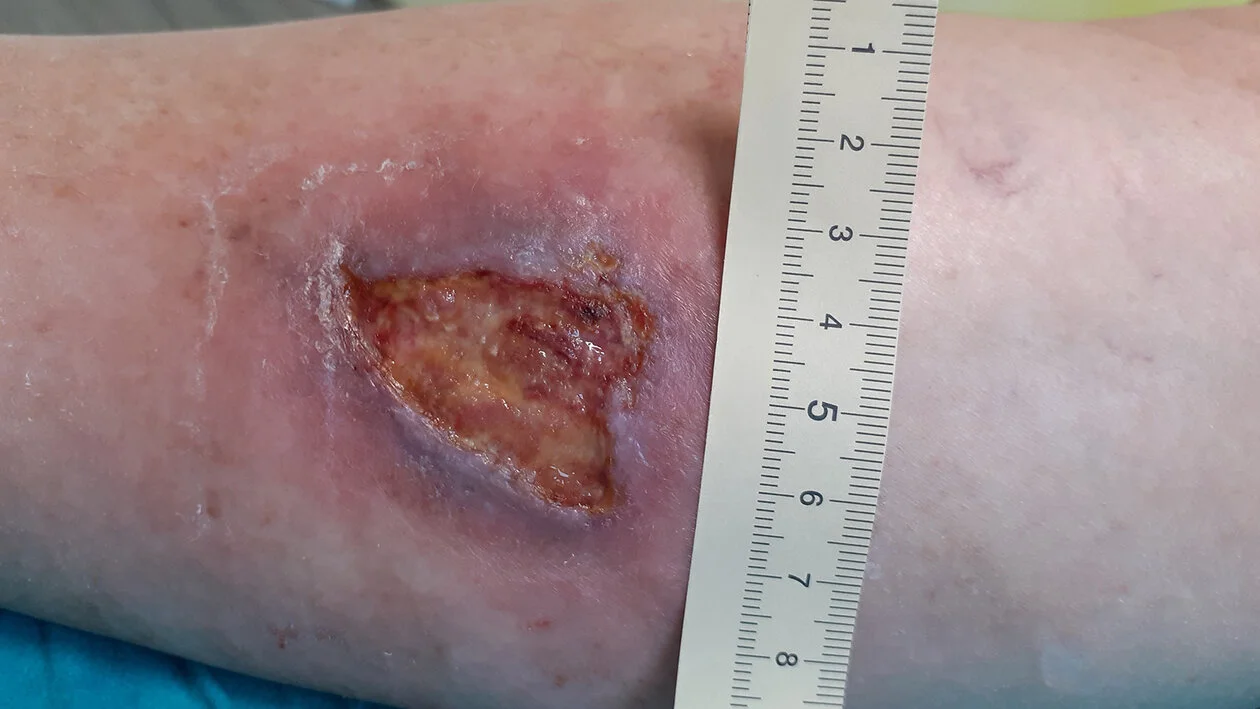 Pyoderma gangraenosum, Vorher-Bild