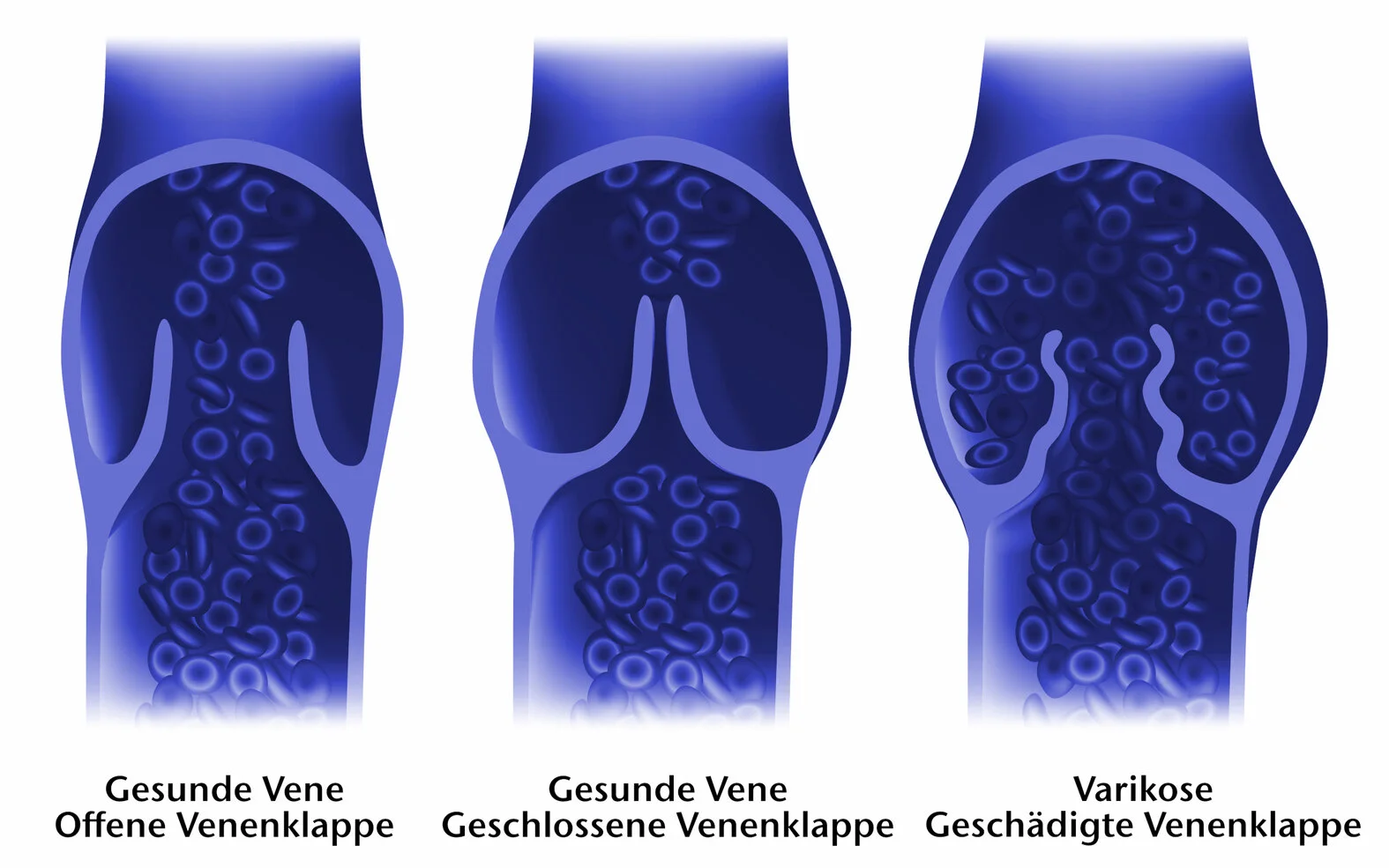 Venenklappen, gesund, Varikose