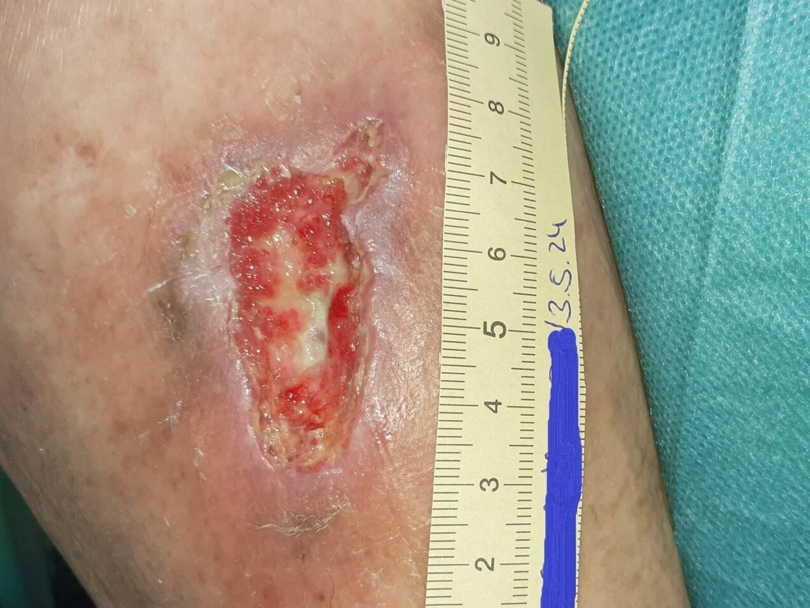 Pyoderma gangraenosum, verbesserte Wundsituation, beginnende Granulation