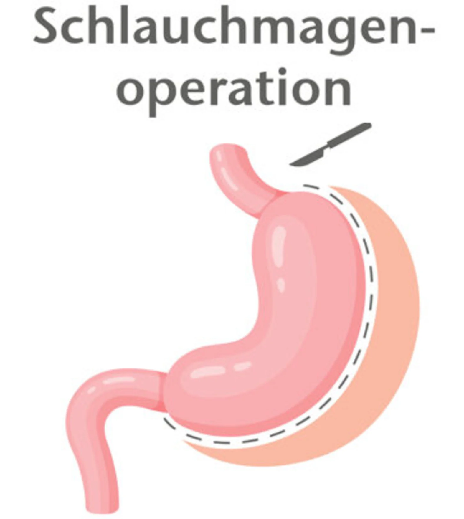 Schlauchmagenoperation, Adipositaschirurgie (Schema)