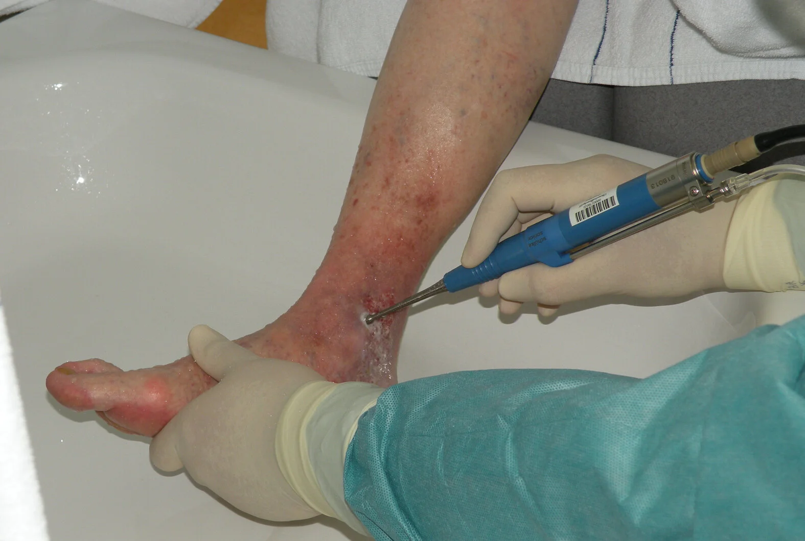 Ultraschallassistierte Wundreinigung (UAW), Fußwunde, Detail