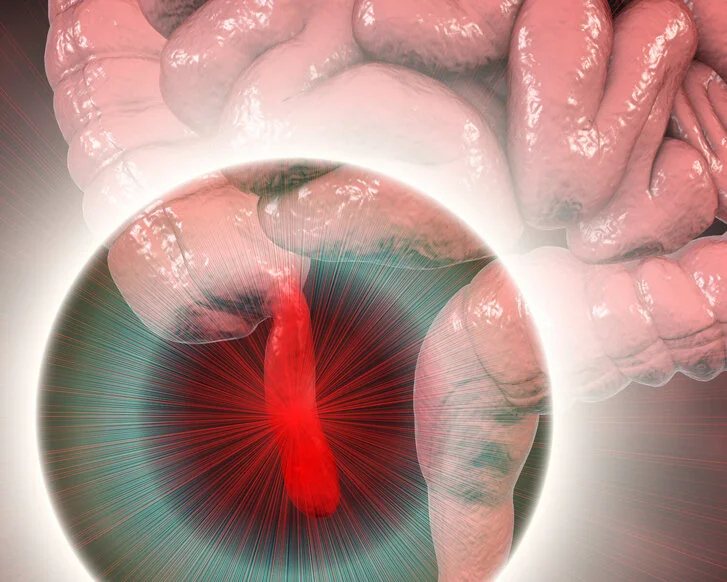 Appendizitis, schematische Darstellung