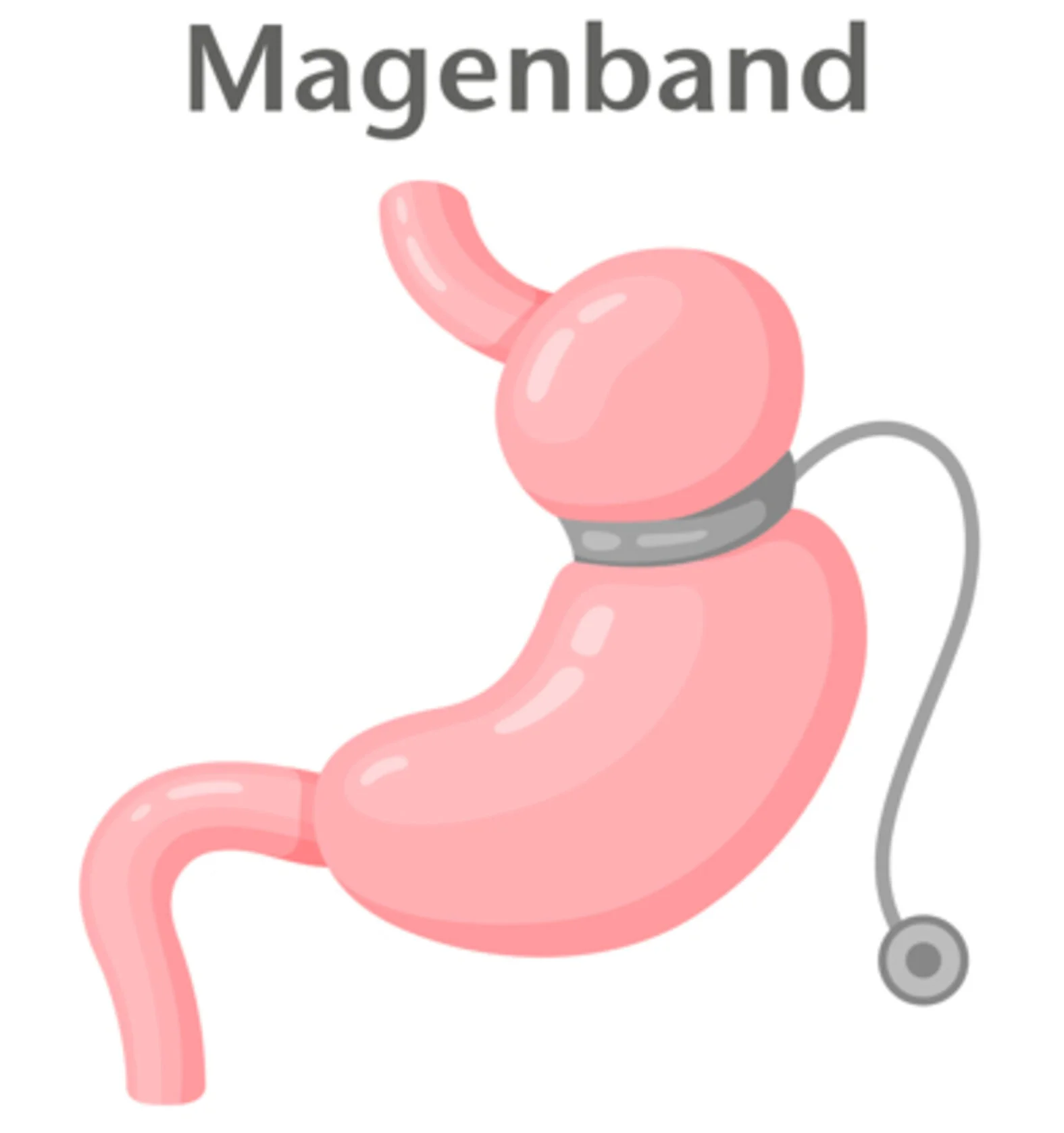 Magenband bei Adipositas, schematische Darstellung