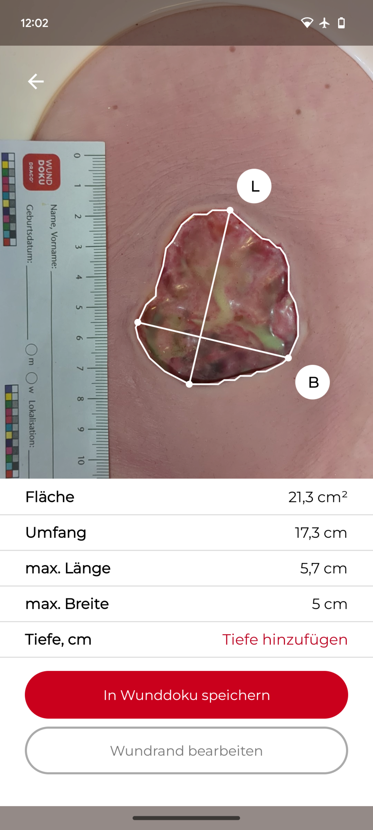 Wunddoku-App: Erfassung der Wundgröße