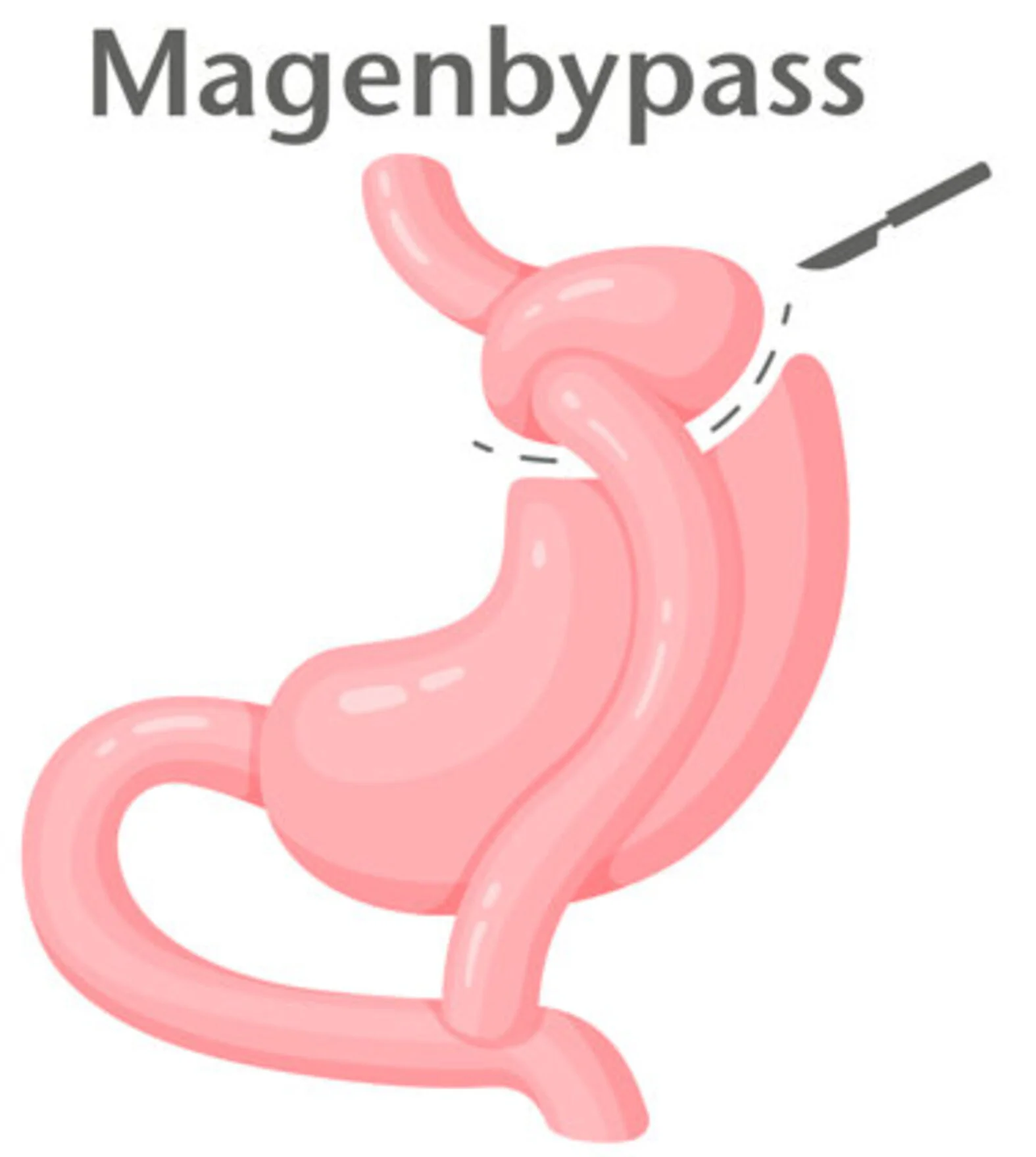 Magenbypass bei Adipositas, schematische Darstellung