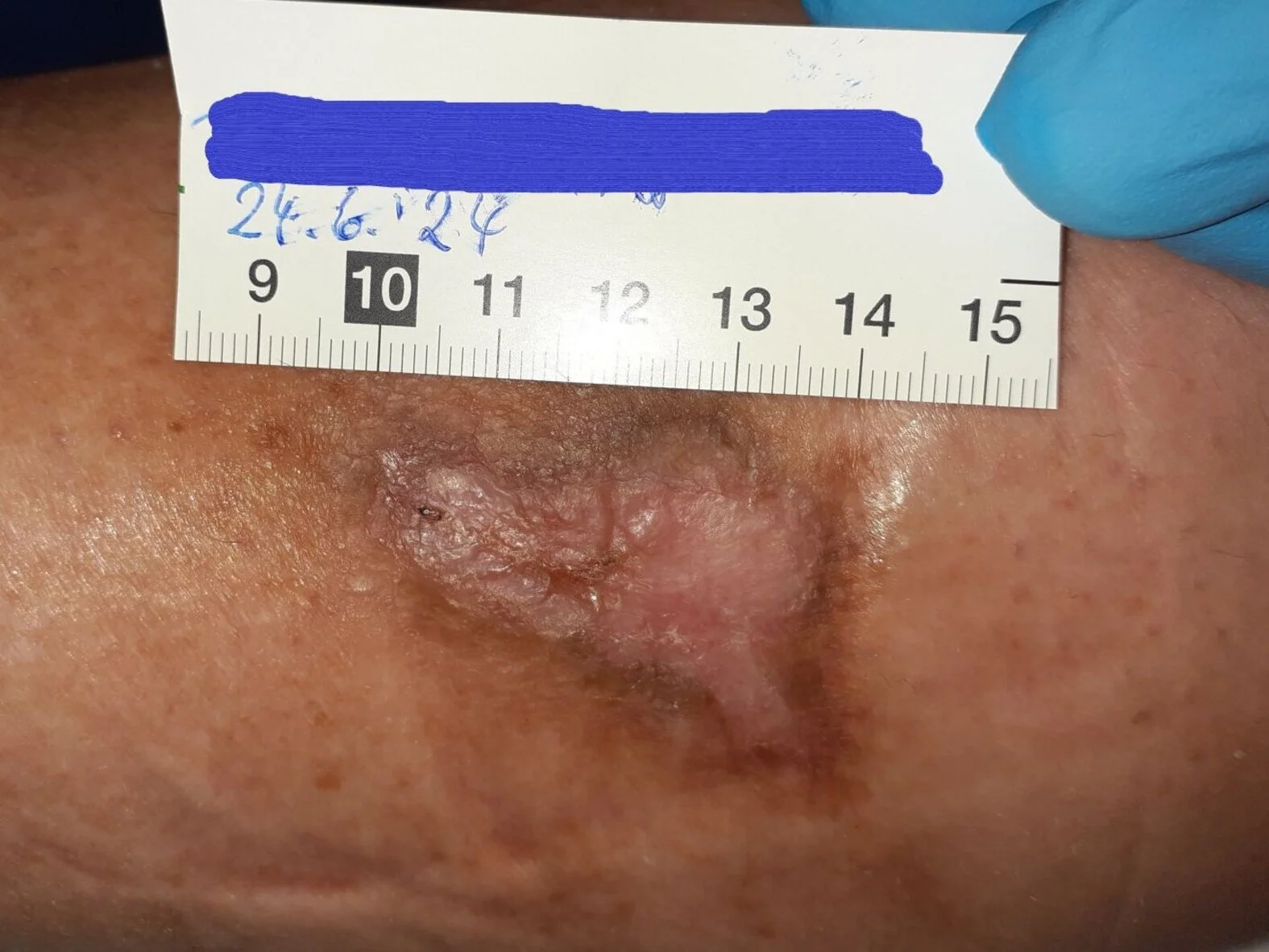 Pyoderma gangraenosum, abgeschlossener Heilungsprozess